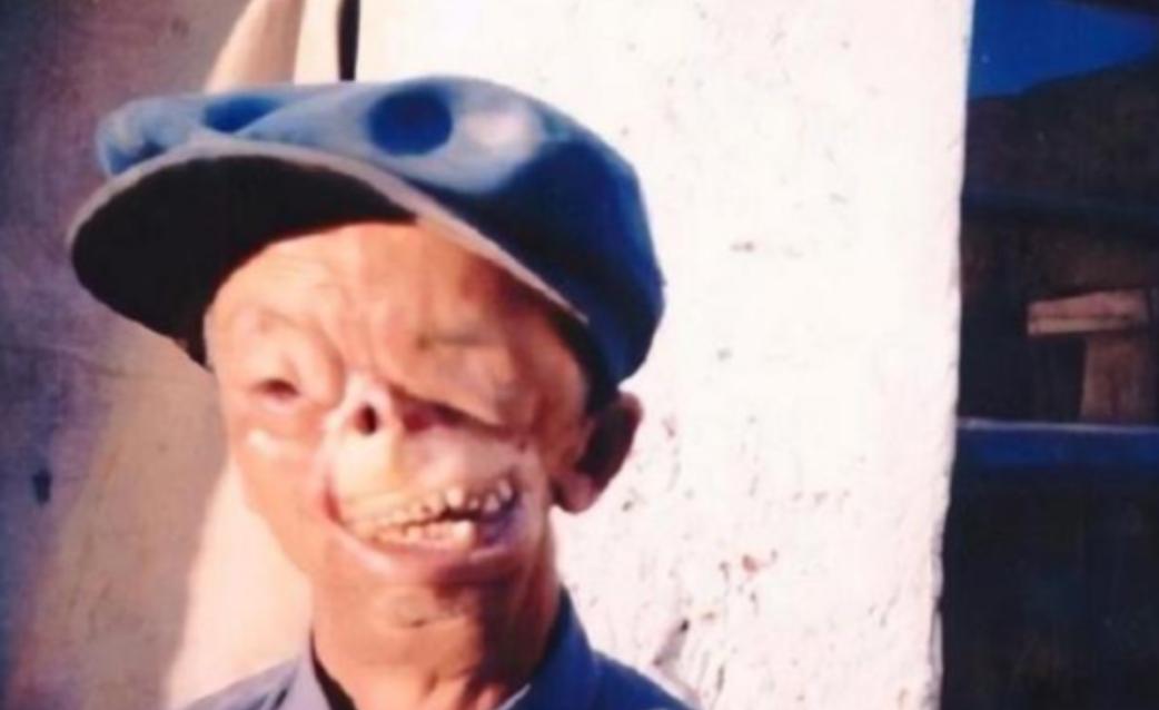 1950年，3岁的他被狼咬掉了半张脸后，被父亲无情的扔到山洞中，没想到他却顽强的