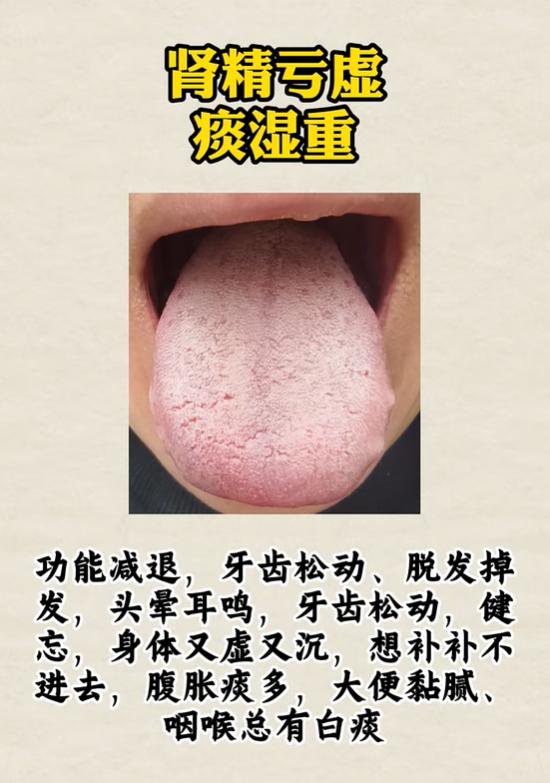 脱发怕冷、潮湿乏力分四类，看懂舌象，循序渐进调养海绵体状态