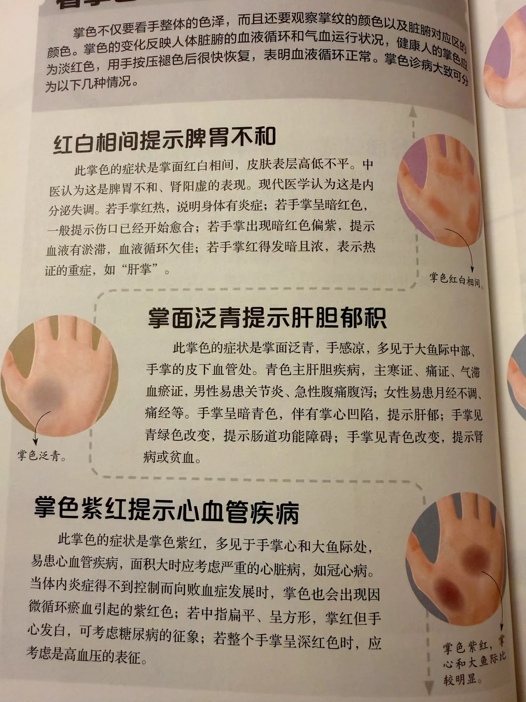 手掌面泛青提示肝胆郁积