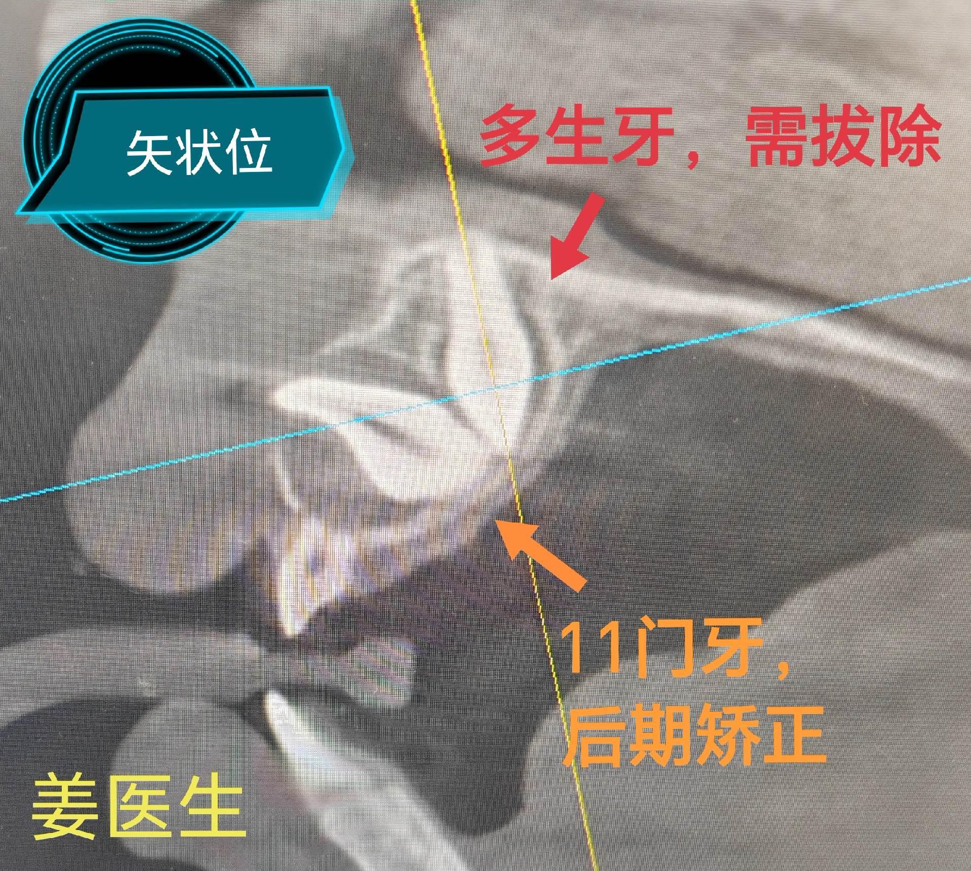 正畸转诊 拔除多生牙一例！8岁小朋友，门牙偏转90度生长，其后上方及鼻...