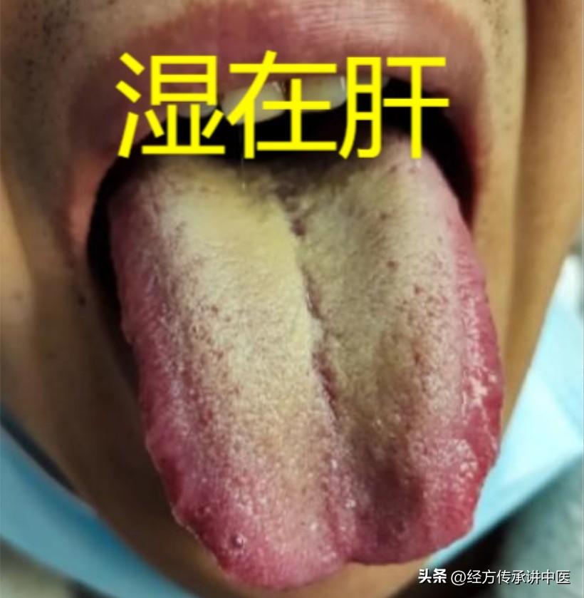 阴囊潮湿：湿在肝，时间短：湿在脾，疲软无力：湿在肾！

1、阴囊潮湿——湿在肝