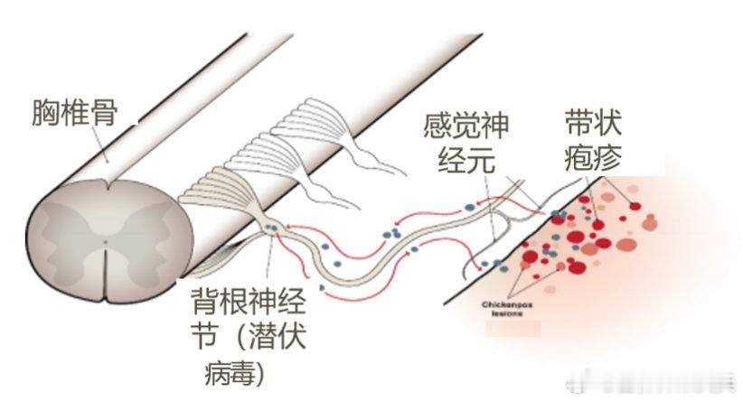 #为什么糖友需警惕带状疱疹##皮肤难题帮帮忙##血糖升高对皮肤有影响吗#如何预防