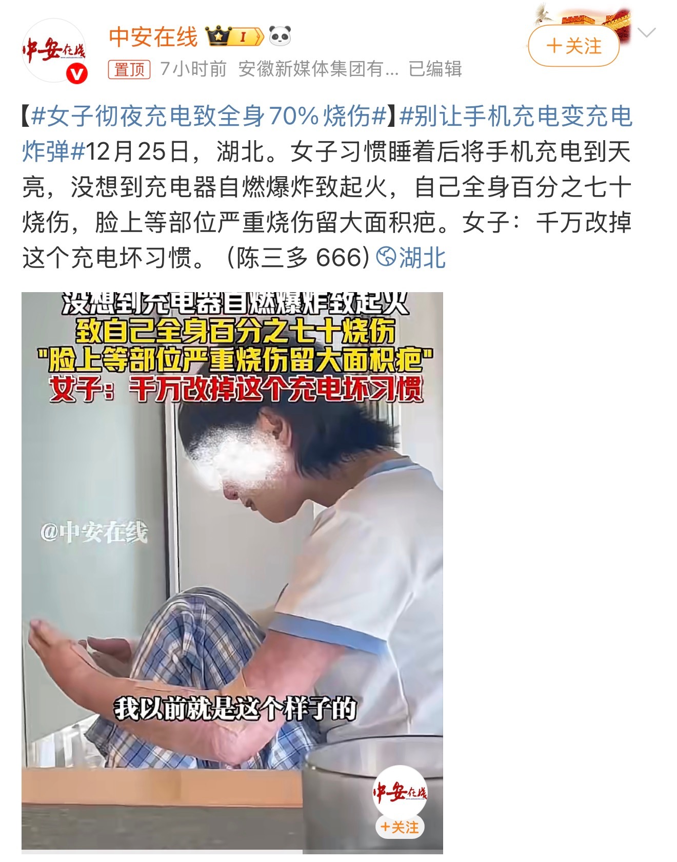 女子彻夜充电致全身70%烧伤看到这条新闻心里一颤，我也经常这样充电，以后真的注意