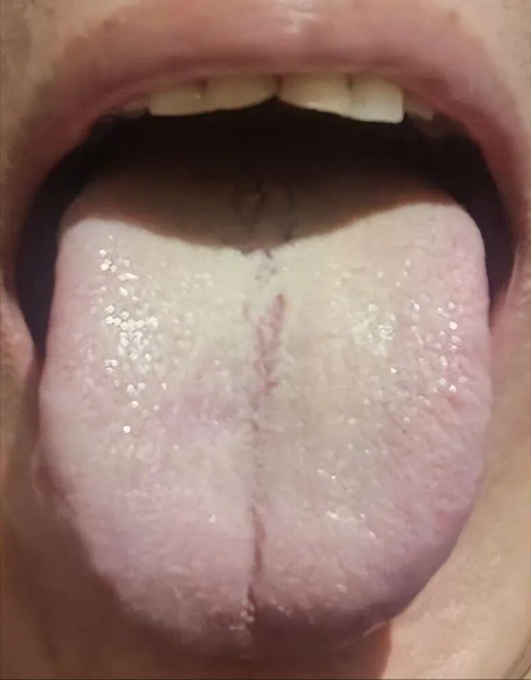脾肾阳虚，温阳散寒是关键！
这种舌象表明湿热症状明显，然而关键在于利用热性药物来