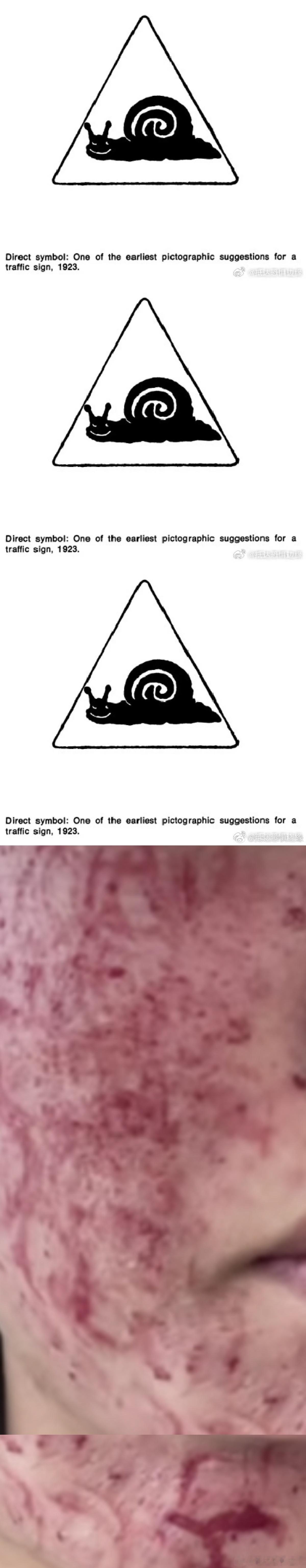 在抖上刷到了做黄金微针（一种美容方法）的视频，做的人整张脸上看着都是🩸淋淋的（