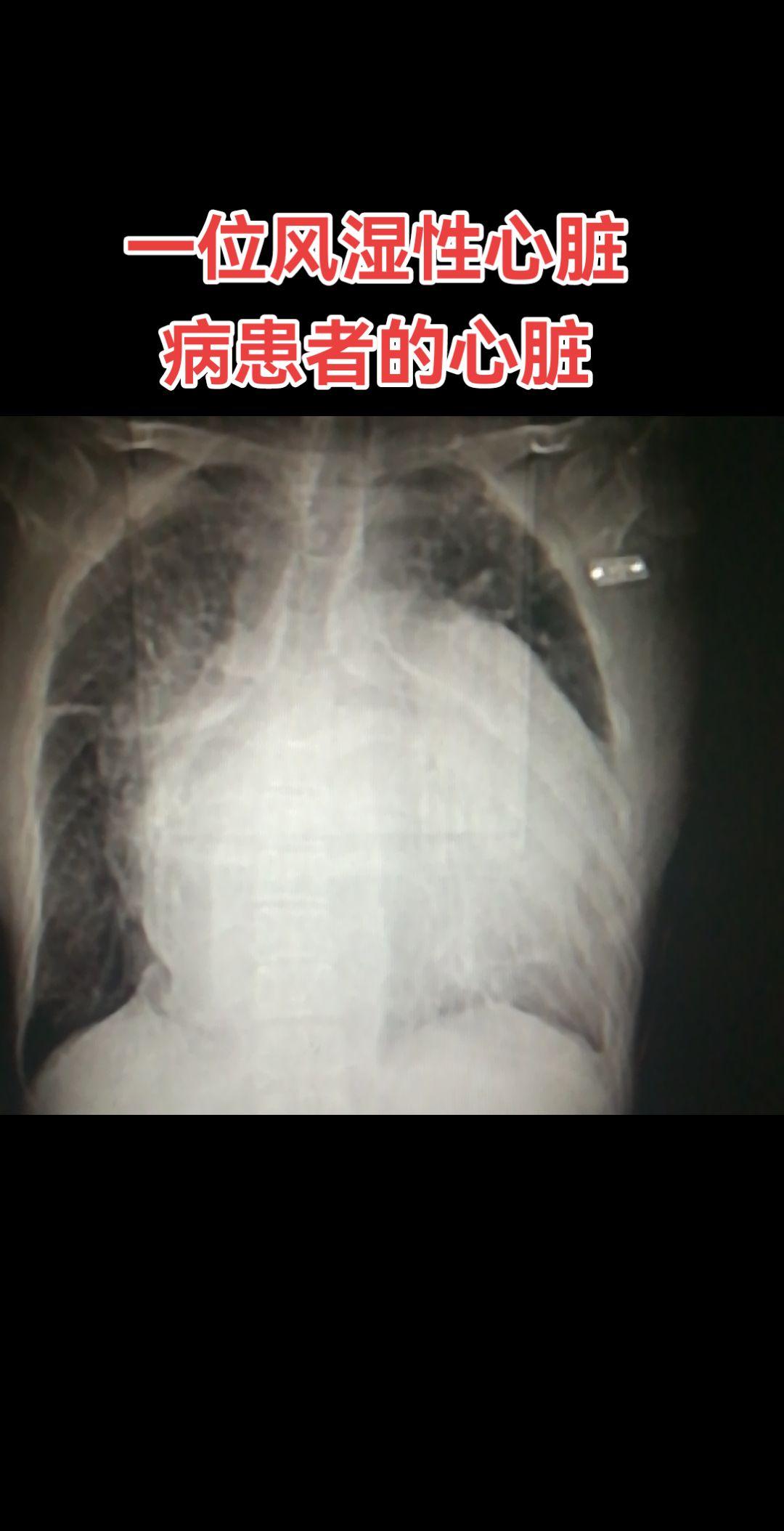 风心病 心力衰竭。