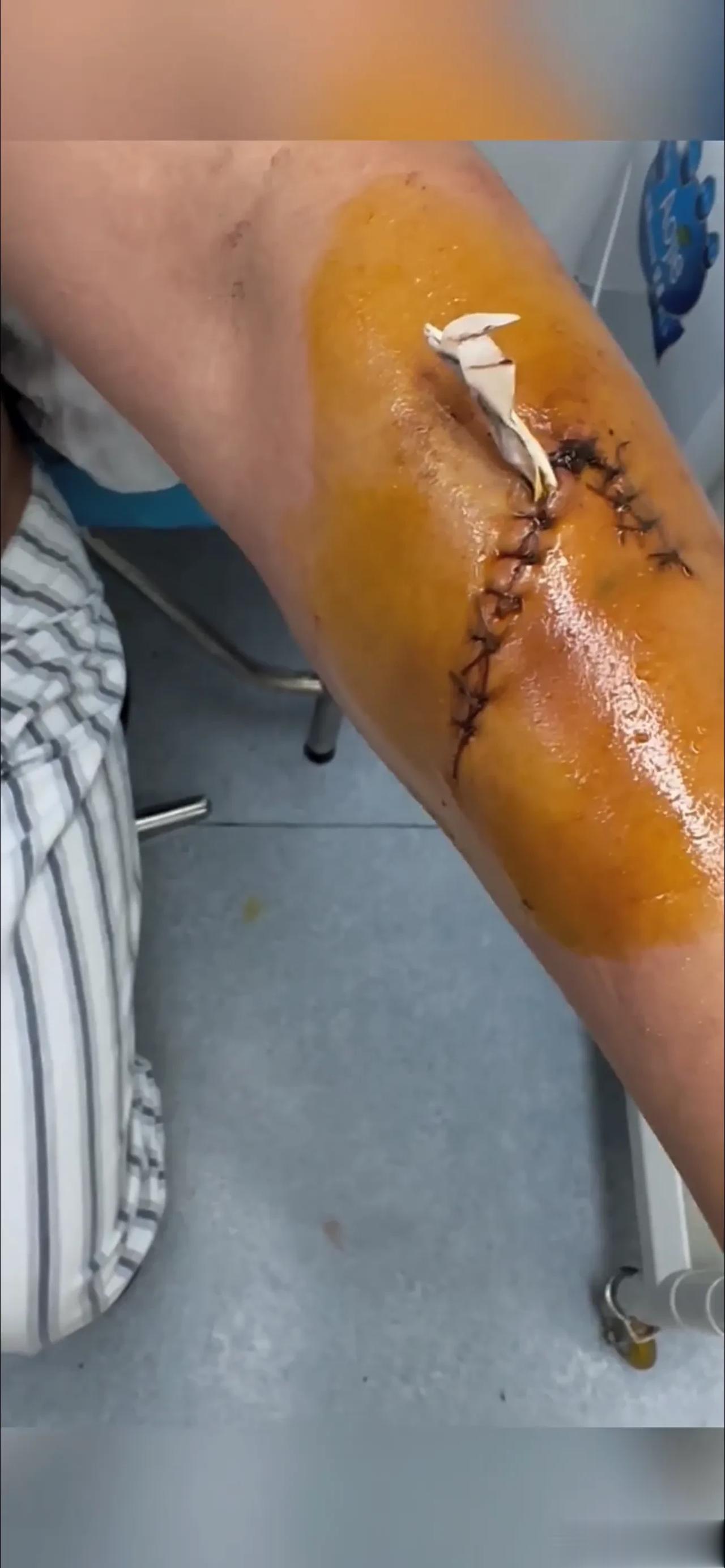 得饶人处且饶人！铁岭小辉讲述被扎伤全过程，网友劝道：尽量赔钱和解，把人送进去太得