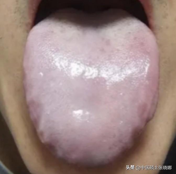 寒到极致，必是淤！这种齿痕水滑舌，只想到健脾祛湿，补阳，大错特错！用啥都白瞎！
