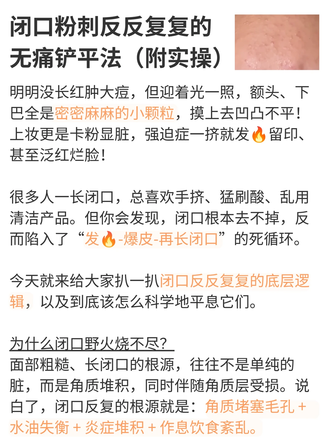 闭口粉刺反反复复的无痛铲平法（附实操