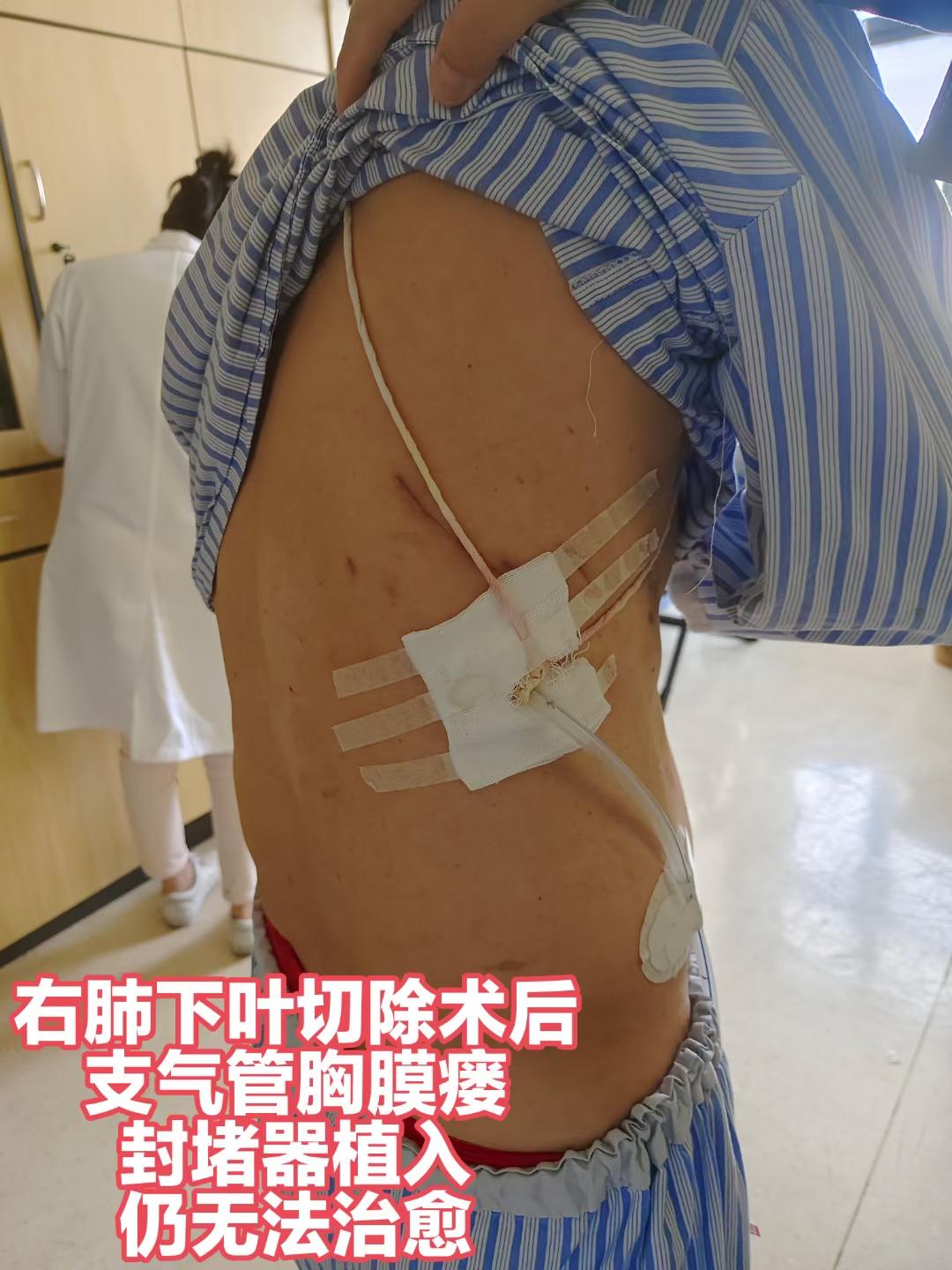 支气管胸膜瘘，不是恶疾，堪比恶疾，患者家属无望，医生痛苦万分。我们的独...