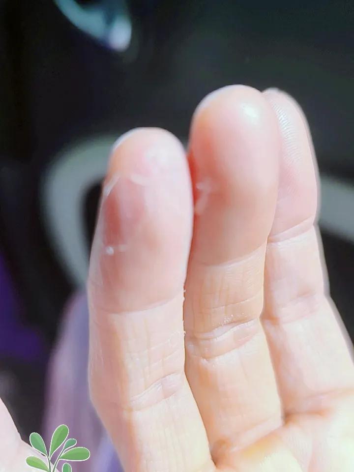 到了夏天，发现我的手开始脱皮。
小手指头又痒又难受。
很可能是跟我洗碗去搞卫生，