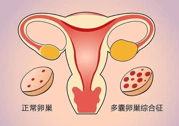 【多囊有优势卵泡吗？影响卵泡发育有哪些原因？】健康真探社在生殖医学的舞台上，多囊