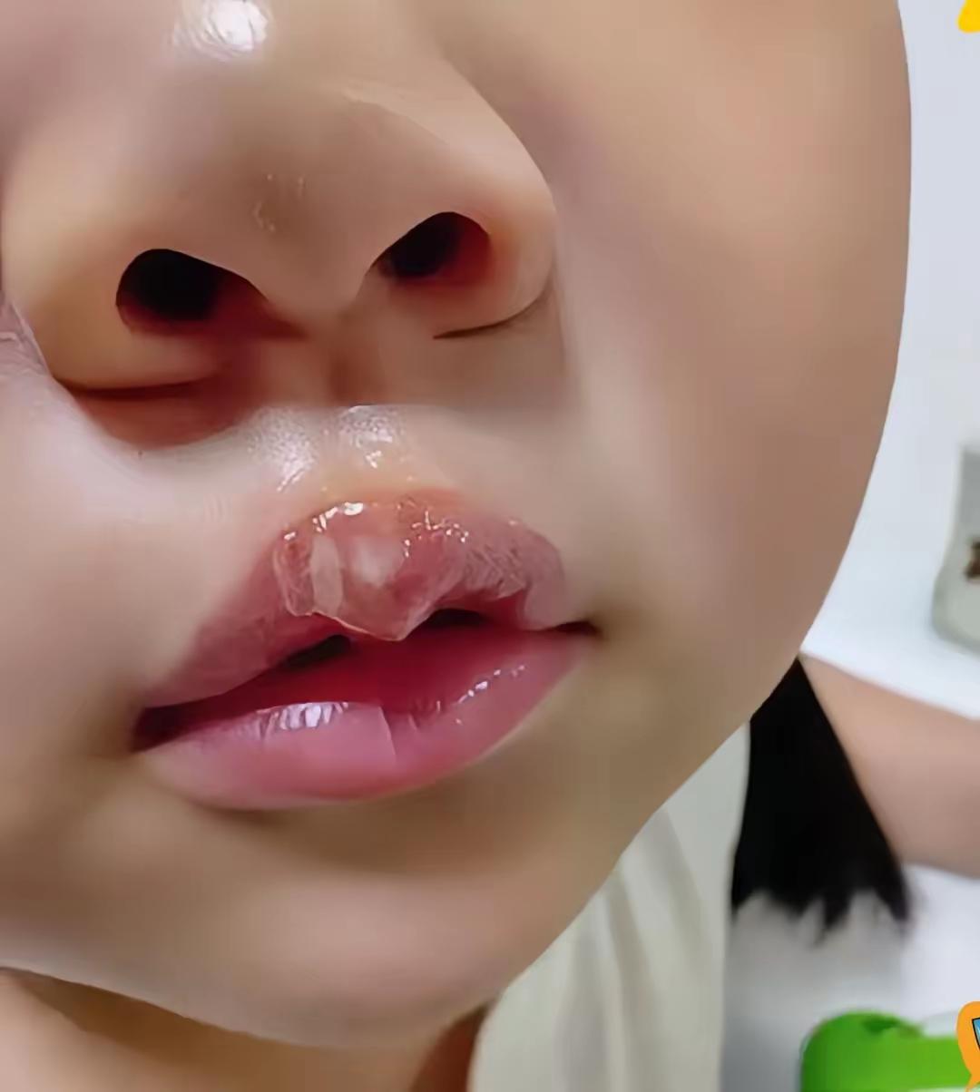 这么可爱的孩子，就因为幼儿园老师所谓的不听话，被女班主任用高达180度的热熔胶烫