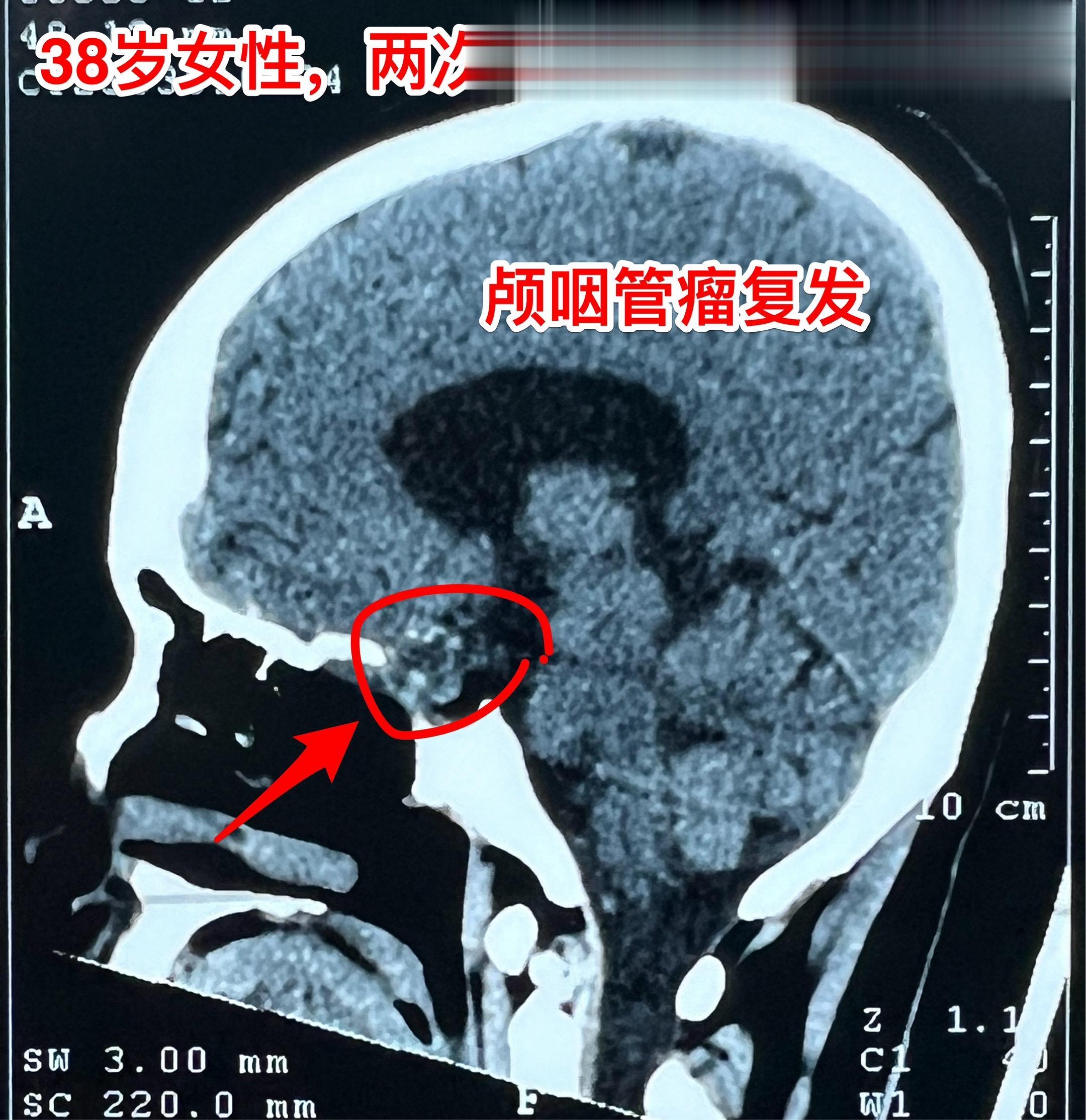 昨天的第四个手术（经鼻复发颅咽管瘤）昨日第四个完成的手术，是38岁女性...