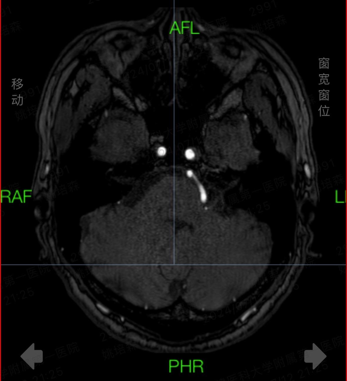 时光晃呀晃。连续10小时颅脑手术，做了一台帕金森病，一台面肌痉挛，一台...