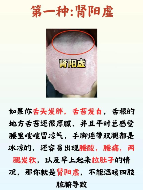 4 种肾虚舌象，一眼分清不同肾虚类型