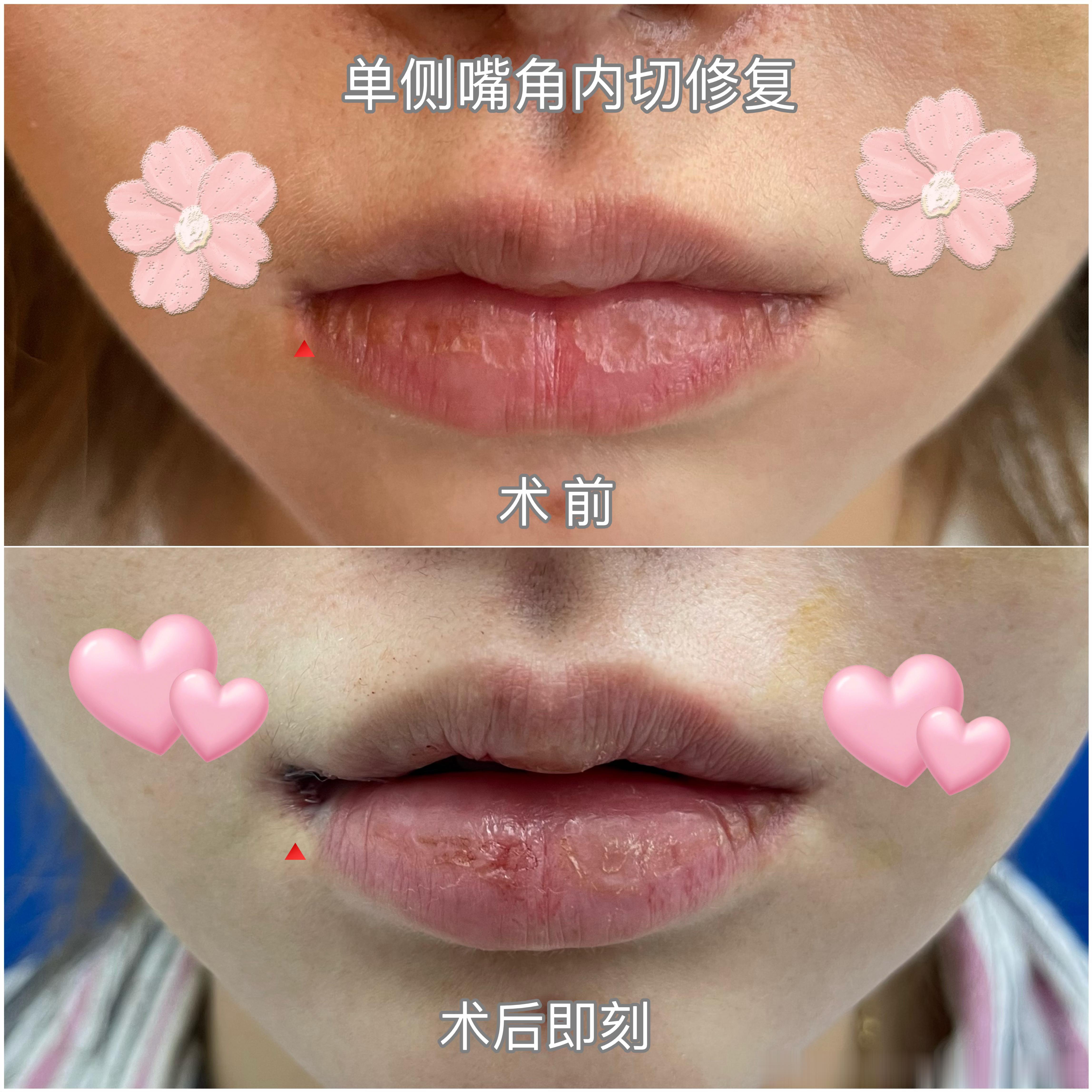 后悔没做另一侧了