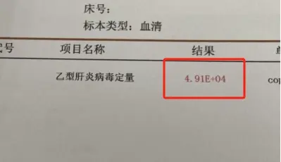 这是一位聊城的乙肝肝硬化患者复查的结果，4次方病毒，双抗治疗仍需努力！