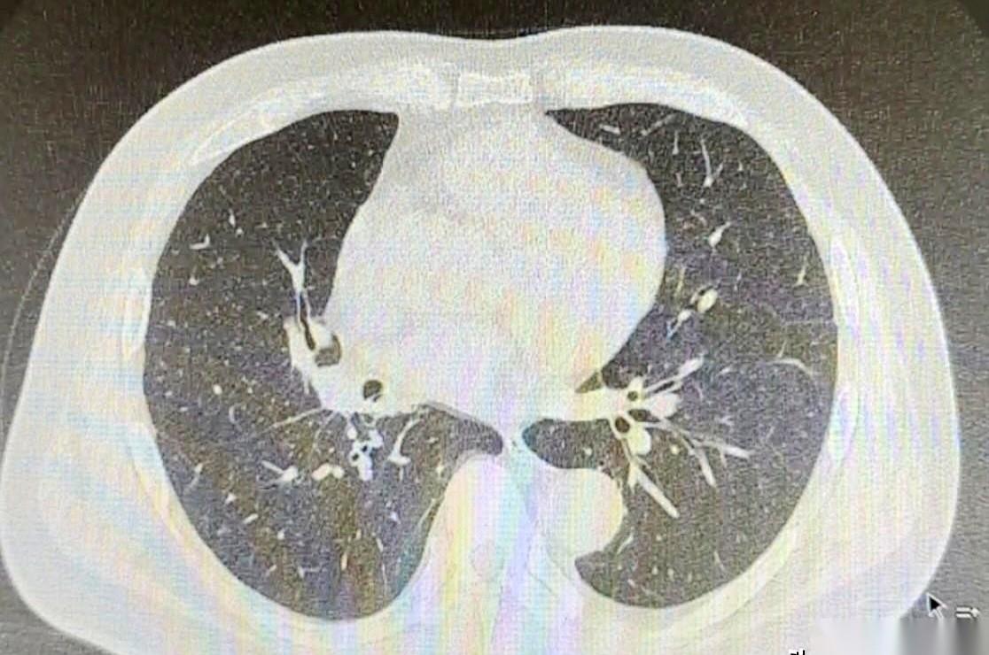 切了整个右肺下叶，半年后CT一扫，胸腔里干干净净，一点积液都没有。
这是天津一个