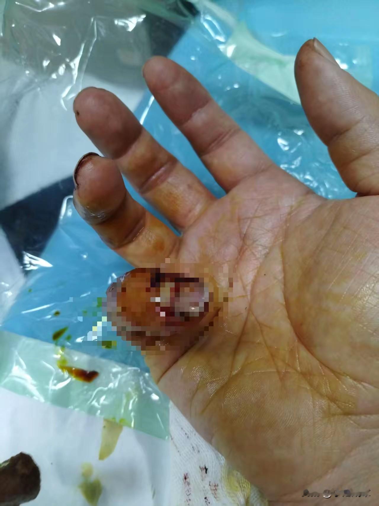 “被城管咬手指”

9月24日，甘肃兰州的张先生在店里忙活，突然来了4名城管，要
