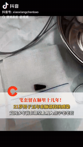 湖南长沙，一21岁男子反复咳嗽五年不见好，直到有一次他咳的胸口疼就去医院检查，结