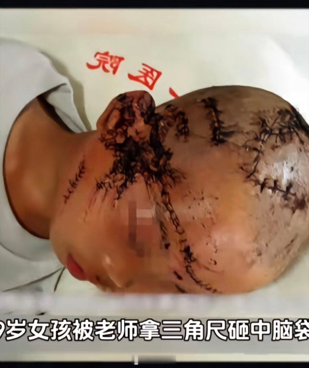 老师用三角尺砸伤女童获刑5年  5年看似很重了，但是女孩脑浆子都被砸出来了，钢尺
