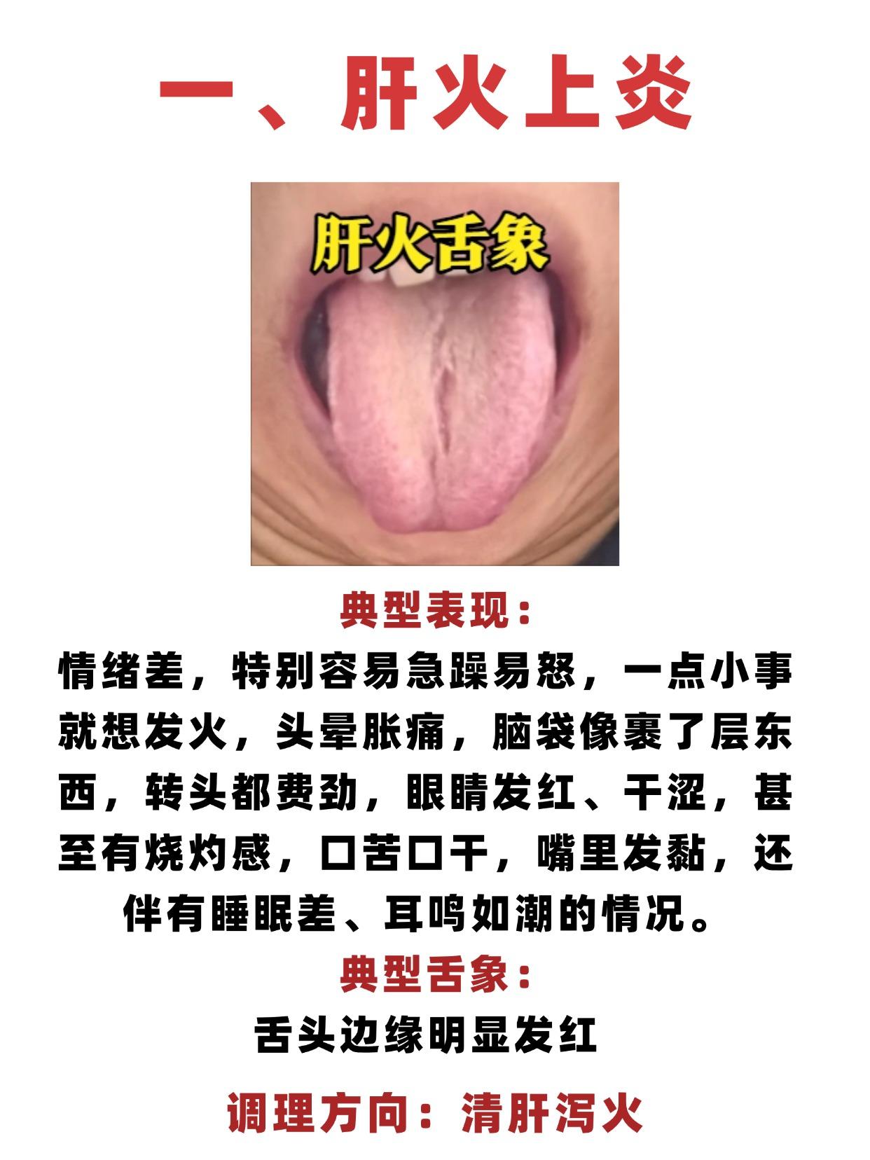 “上火” 分3种类型，舌象一看便知