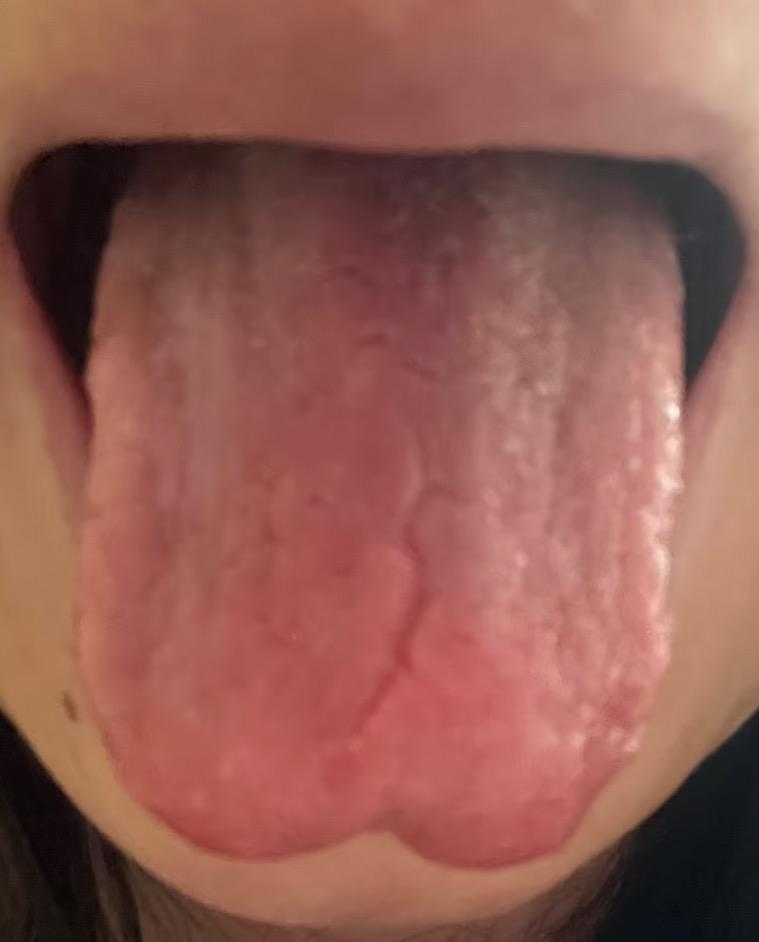 这种舌象调理别踩坑！心气虚不直补，脾虚不猛健，根源在津血源头没劲儿
大家好，我是