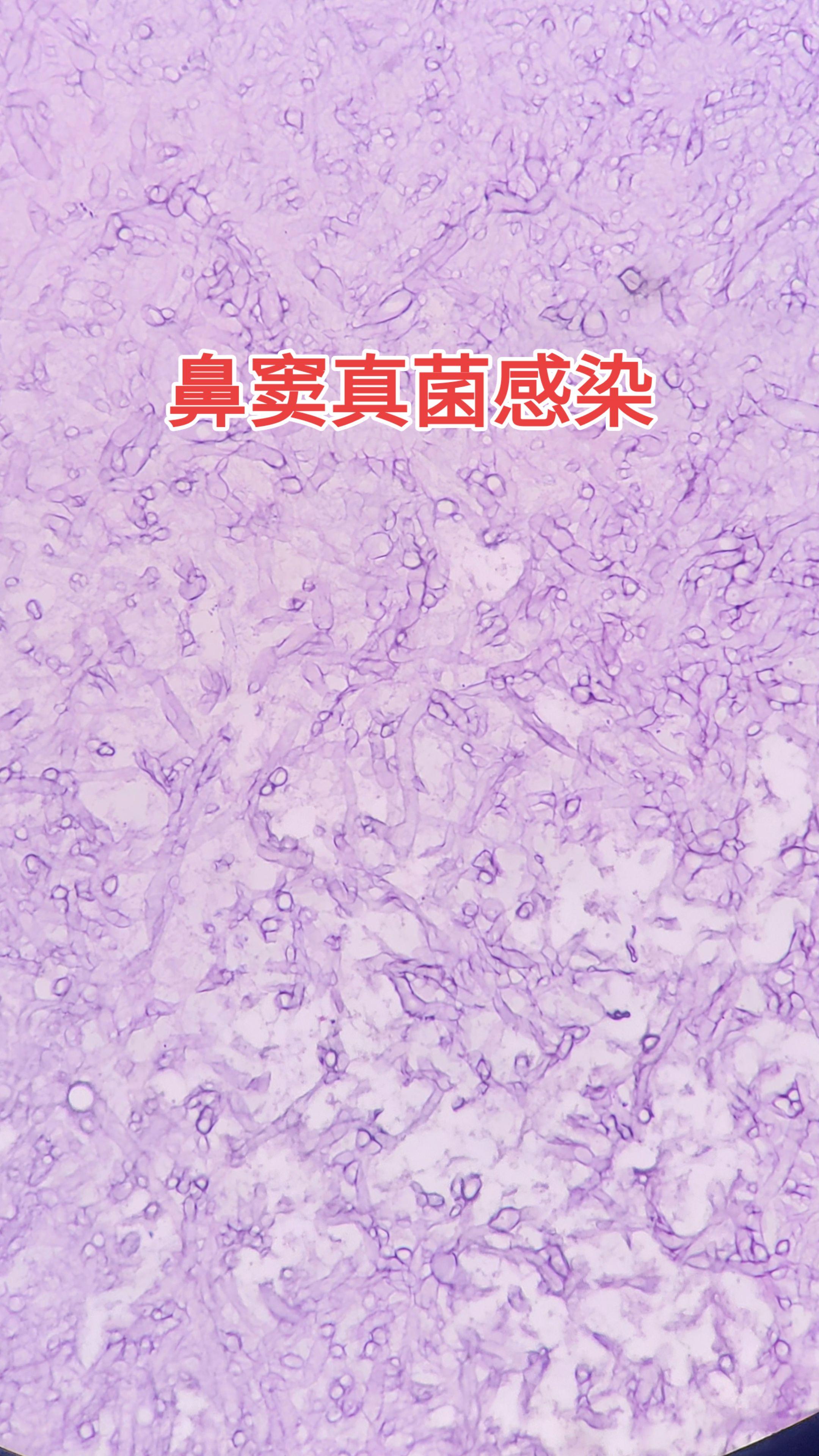鼻窦炎 真菌