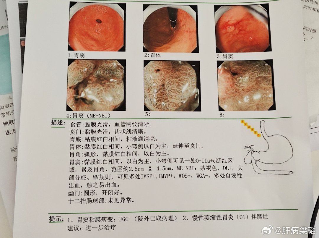 今天又做了一个跟之前一样的，两个病例有点一样，图二病理结果为灶性高瘤。这就是比较