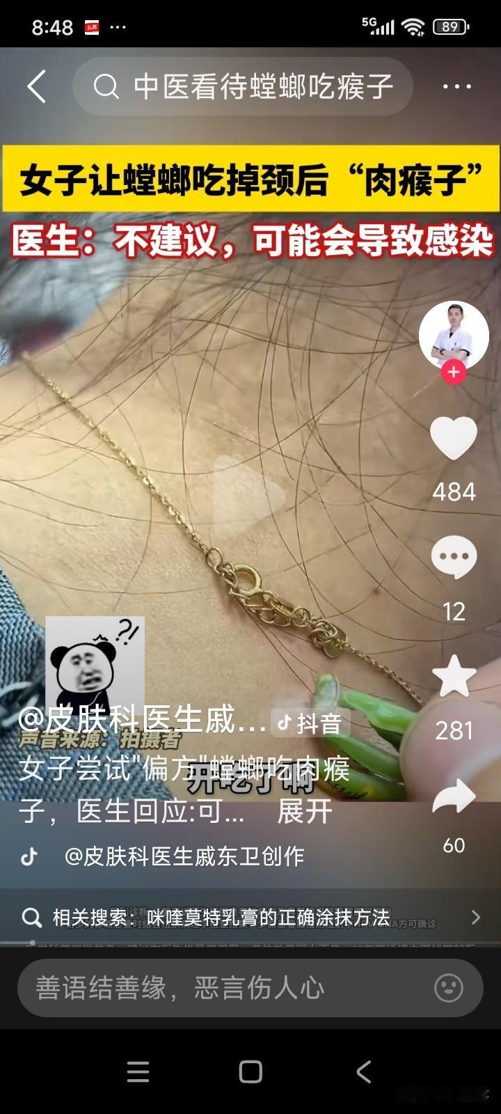 四川成都，有个女子脖子后面长了个肉猴子。
女子捉了只螳螂，让它帮忙咬掉肉猴子，过