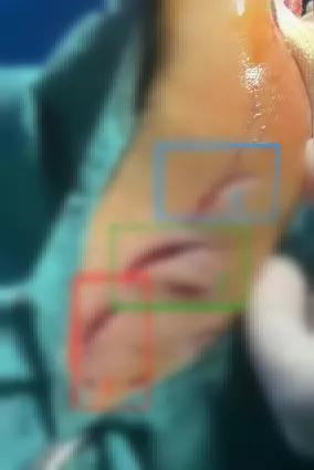 广西侨港海滨浴场的游客被鱼类咬伤事件，目前根据多方人士推测，最大的可能性是海鳗。