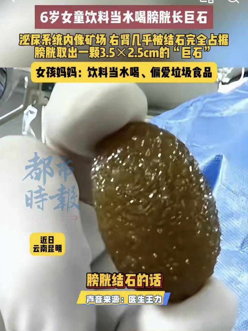 在昆明，一个令人心痛的病例引发了关注。一名6岁的小女孩，因为长期把饮料当水喝、特