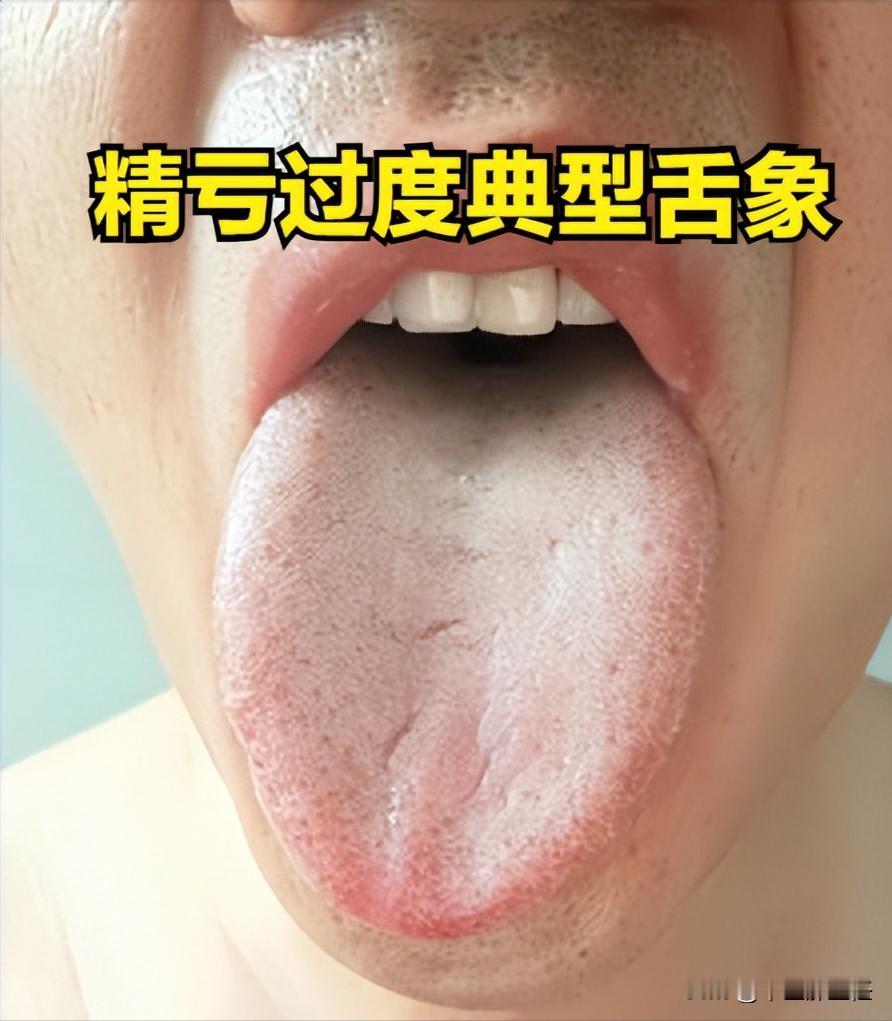 裂纹舌分三种，阴虚，阳虚、血虚分不清，越补越虚！
先说阴虚裂纹舌，舌头鲜红，裂纹