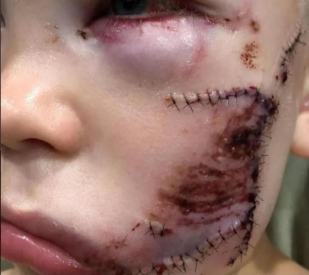 这个小男孩从一只牧羊犬口中救出了他的小妹妹，他全身缝了90针，但把他三岁的妹妹从