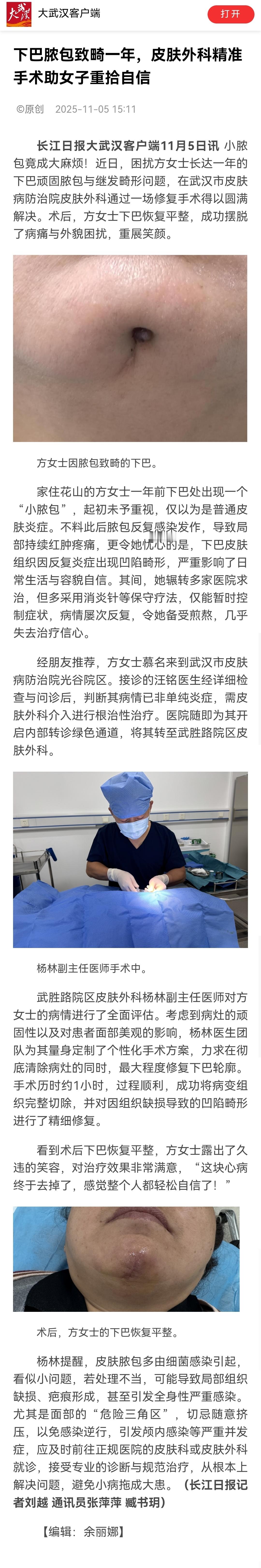 这不是脓包，是牙源性皮窦，外科手术没用的，得处理病灶牙，否则复发率100%口腔科