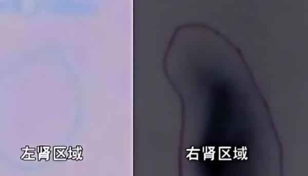 一颗腰子没了？2012 年陕西女子顺利考入国企，入职体检竟查出左肾凭空消失。她怀