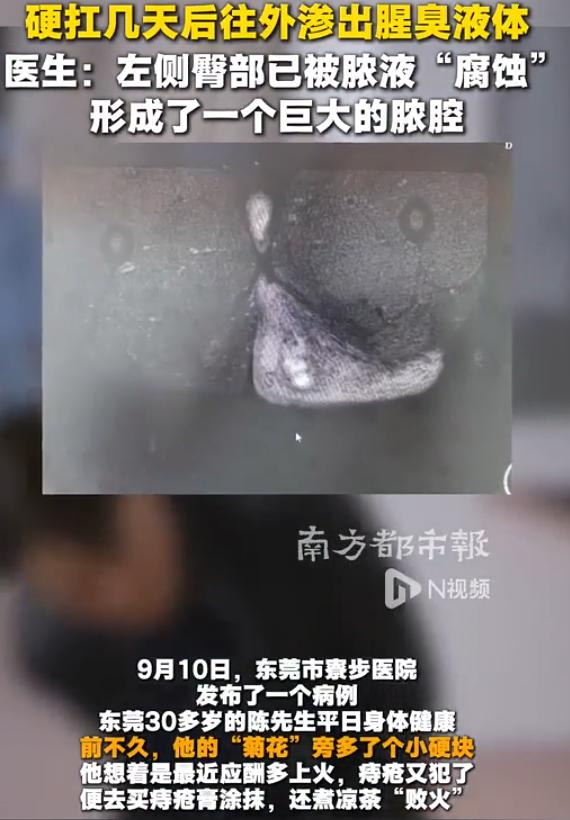 悲剧还是发生了！”9月11日南方都市报报道，广东东莞一名男子屁股长了硬块，他以为
