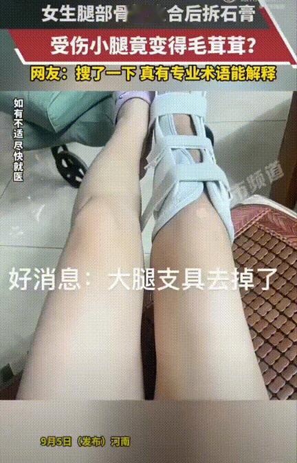 差点解释不清了！河南一女生右小腿骨折，愈合后拆掉了腿部支具，突然惊恐的发现自己右