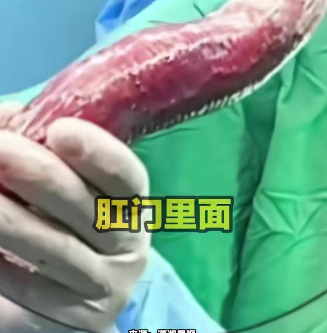 太逗了！
四川成都一位61岁的男子，把一根17厘米长的红薯塞进肛门，结果卡住了。