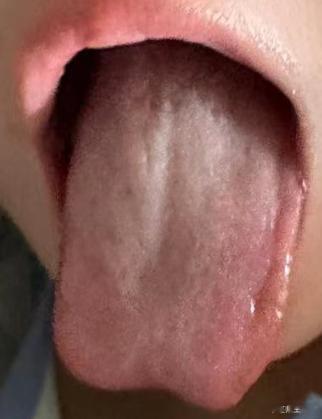 中医的汗法，为治疗发热的常用方法。“体若燔炭，汗出而散”是非常重要的。 ​​​