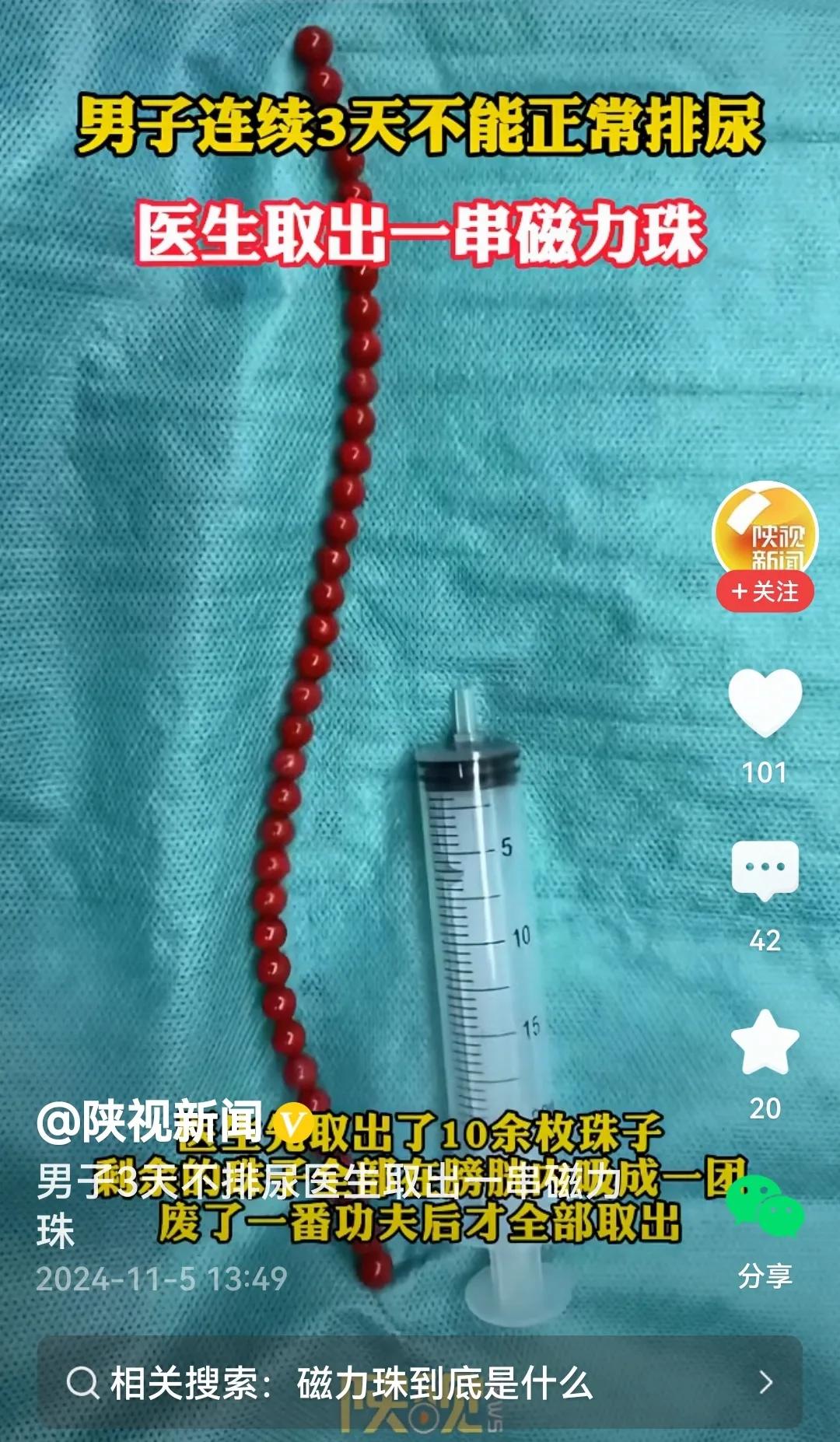 #男子3天不排尿医生取出一串磁力珠#
看过报道坦率讲，我患有肾结石，肾里米粒儿大