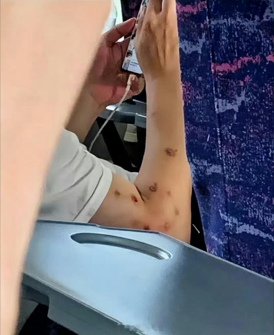 网友坐车发现的，算不算水痘？