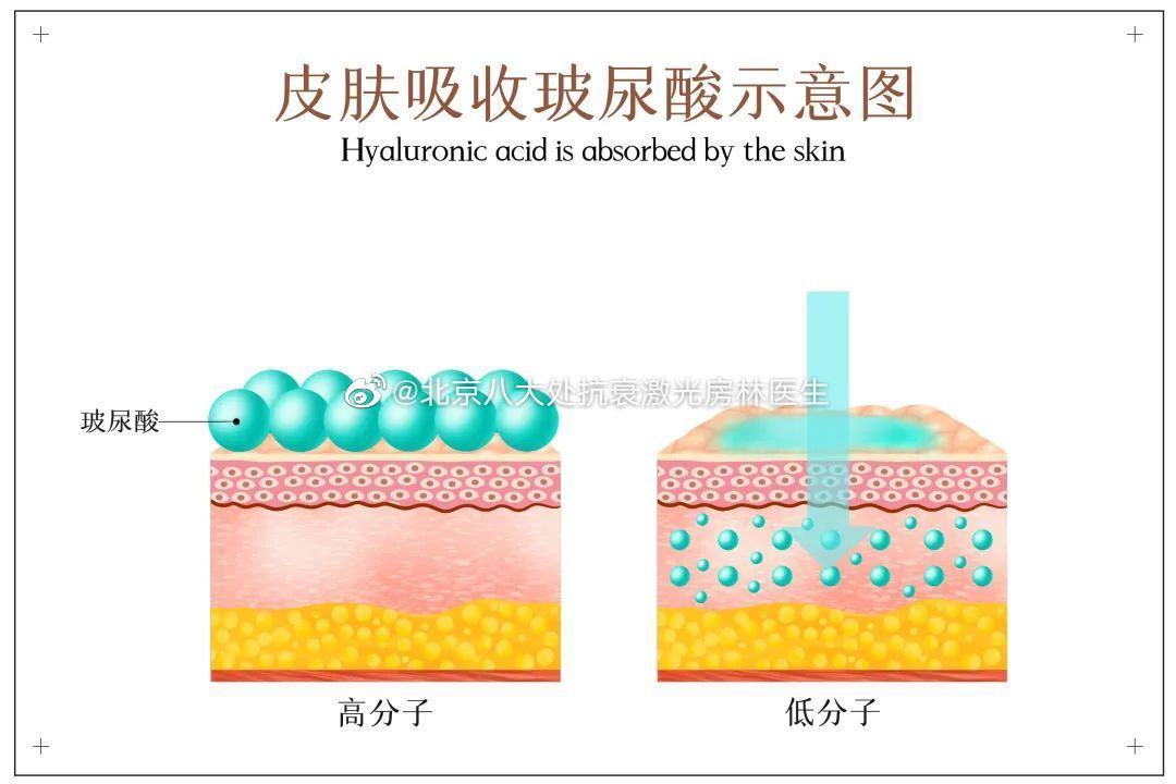 【玻尿酸填充后，皮肤会不会变松弛？】#玻尿酸攻略详解##医美等于变美吗##微博医