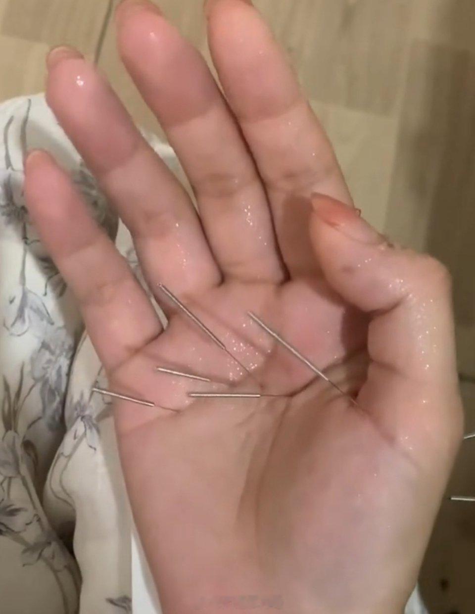 我就腰扭了，给我扎的手，等了20分钟，居然能扶着墙走路了。恕我无知，这手跟腰是有