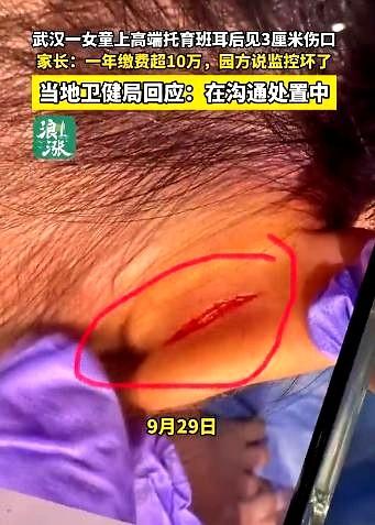 湖北武汉，邓女士孙女在高端托儿所耳朵受伤，医生诊断为大力拉扯撕裂伤。
老师称未目