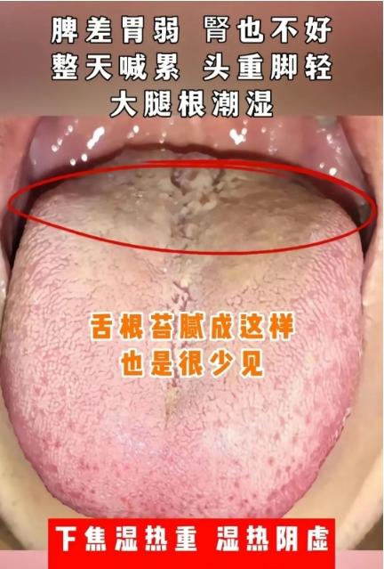 舌根部分代表下焦，舌根问题注意肾的情况。
舌苔腻，一般多考虑是有痰湿之邪，舌苔黄