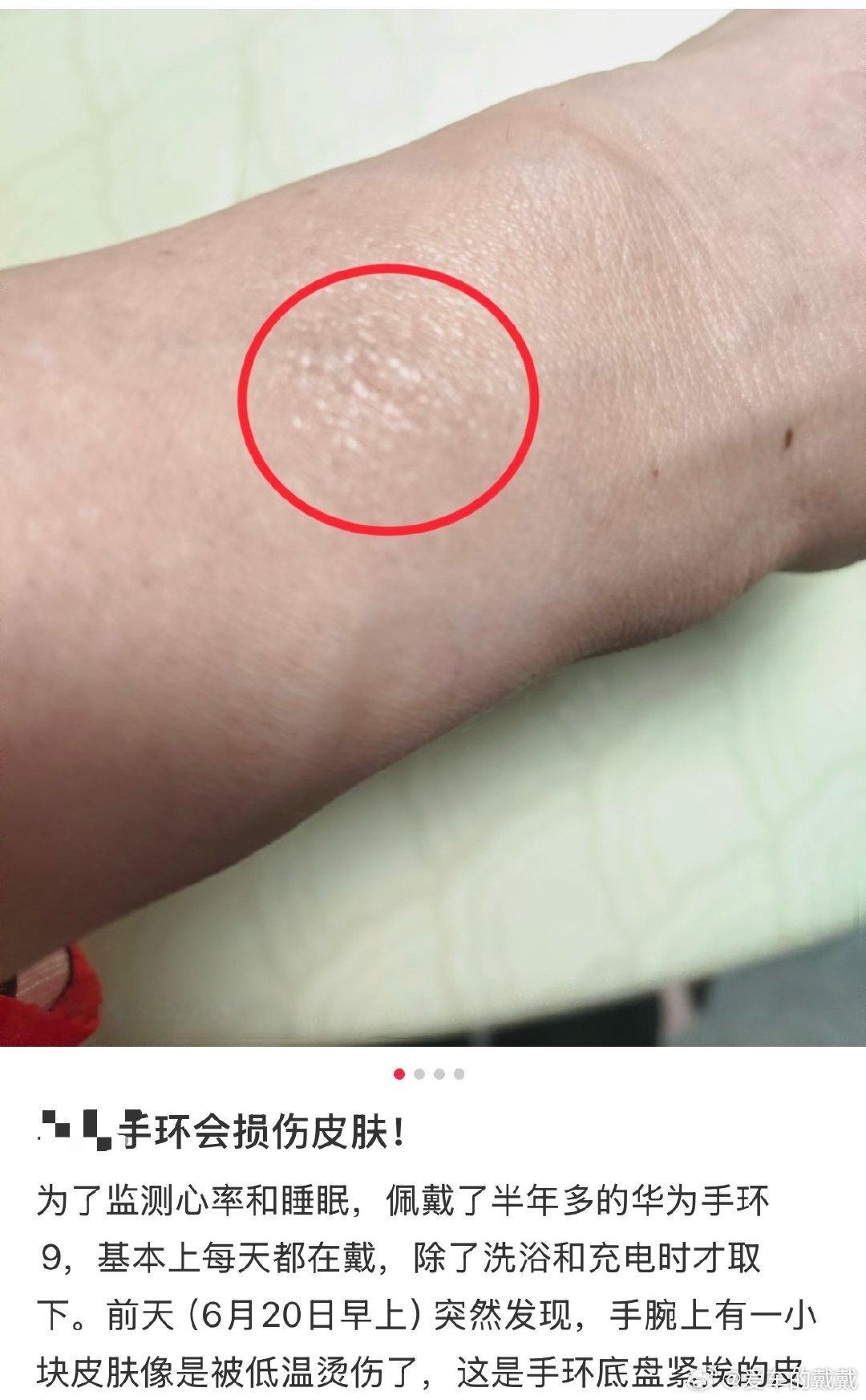 第一批戴运动手环的受害者出现了 我手腕那圈白印子终于找到原因了[泪奔][泪奔][