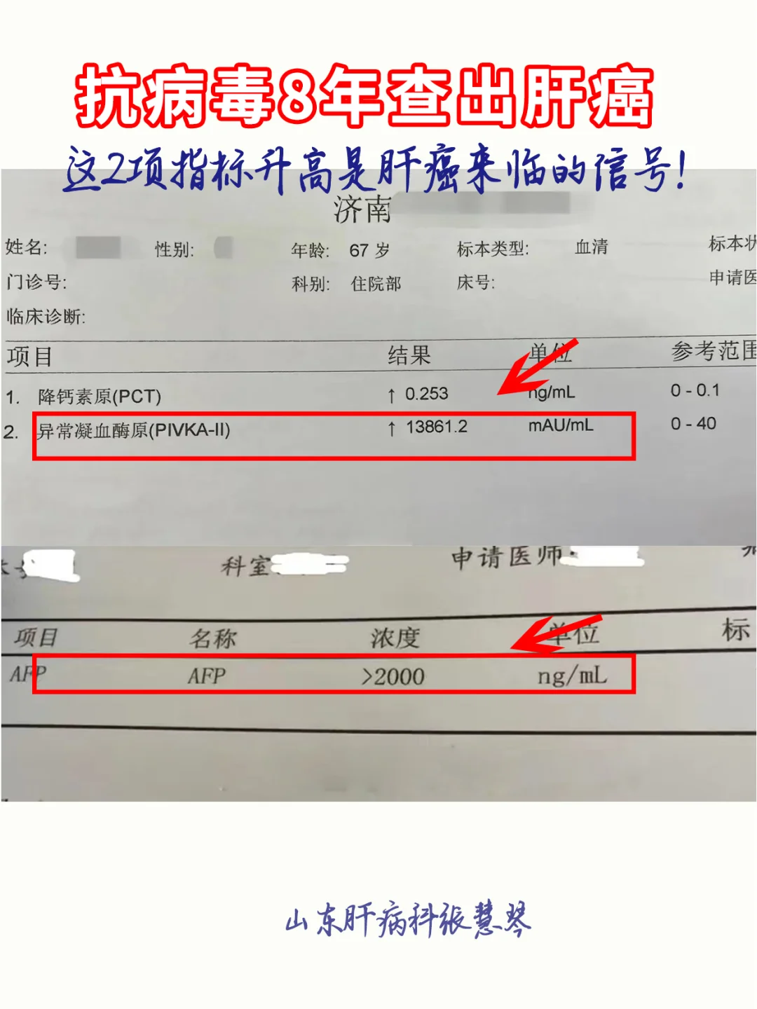 乙肝抗病毒8年查出肝癌，这2个指标升高警惕