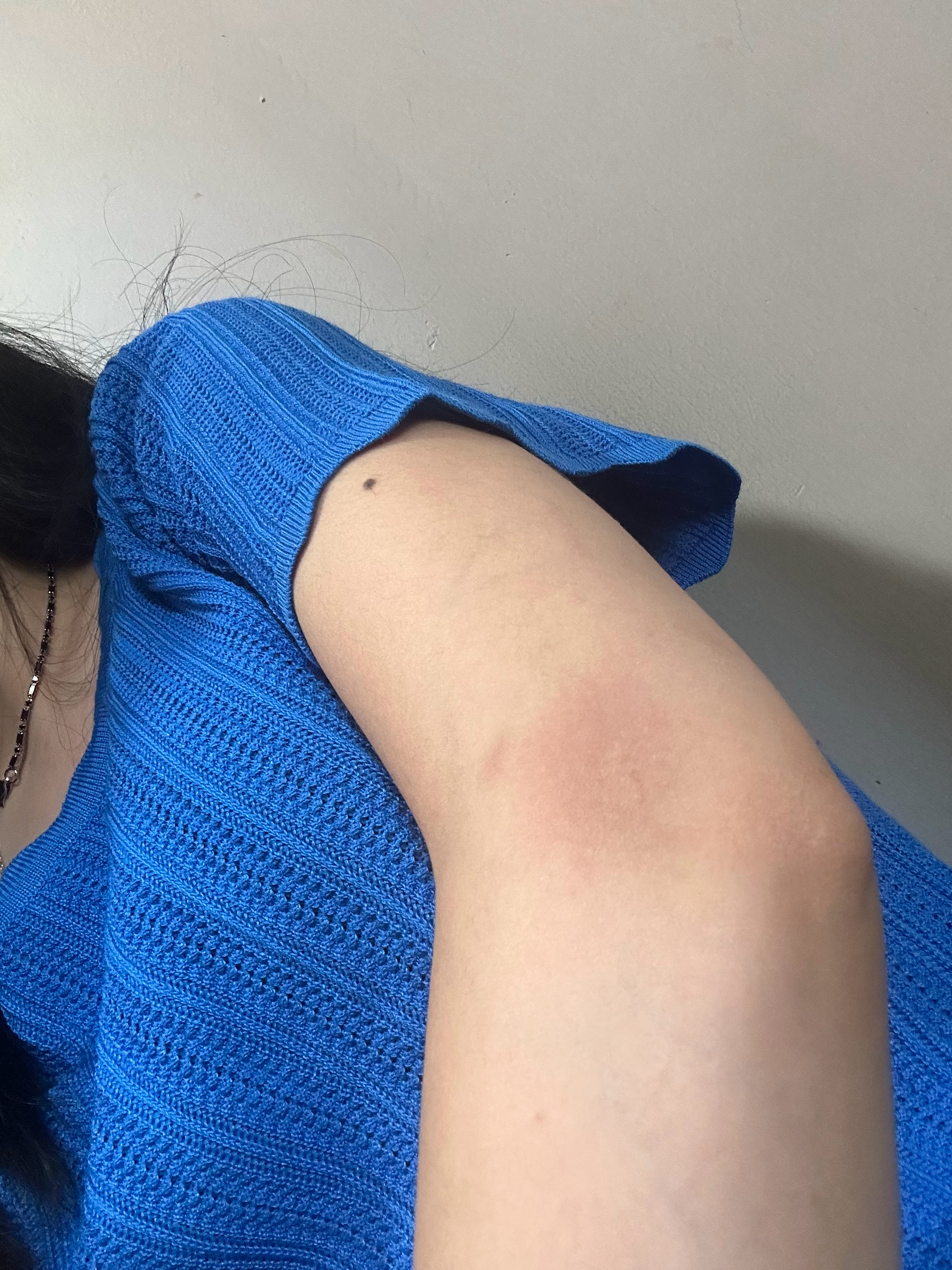 早晨出门打车 坐一半 撞车了 磕了一下红了一天